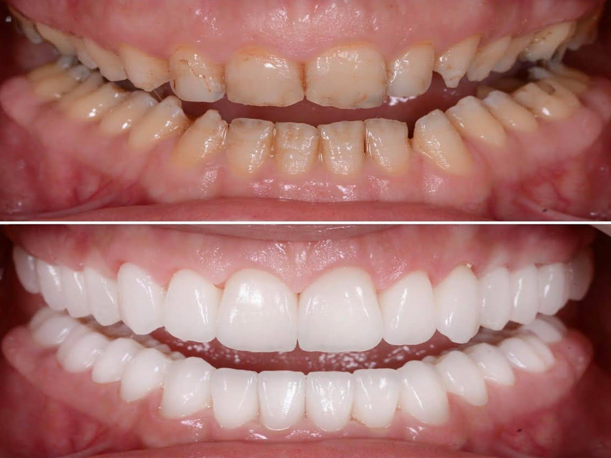 Full Mouth Rehabilitation in Pimple Saudagar