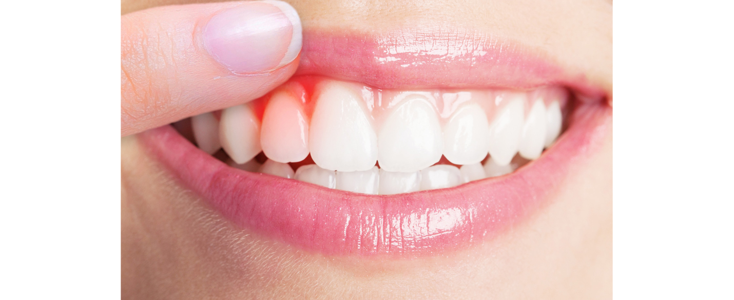 Gum Treatment in Pimple Saudagar