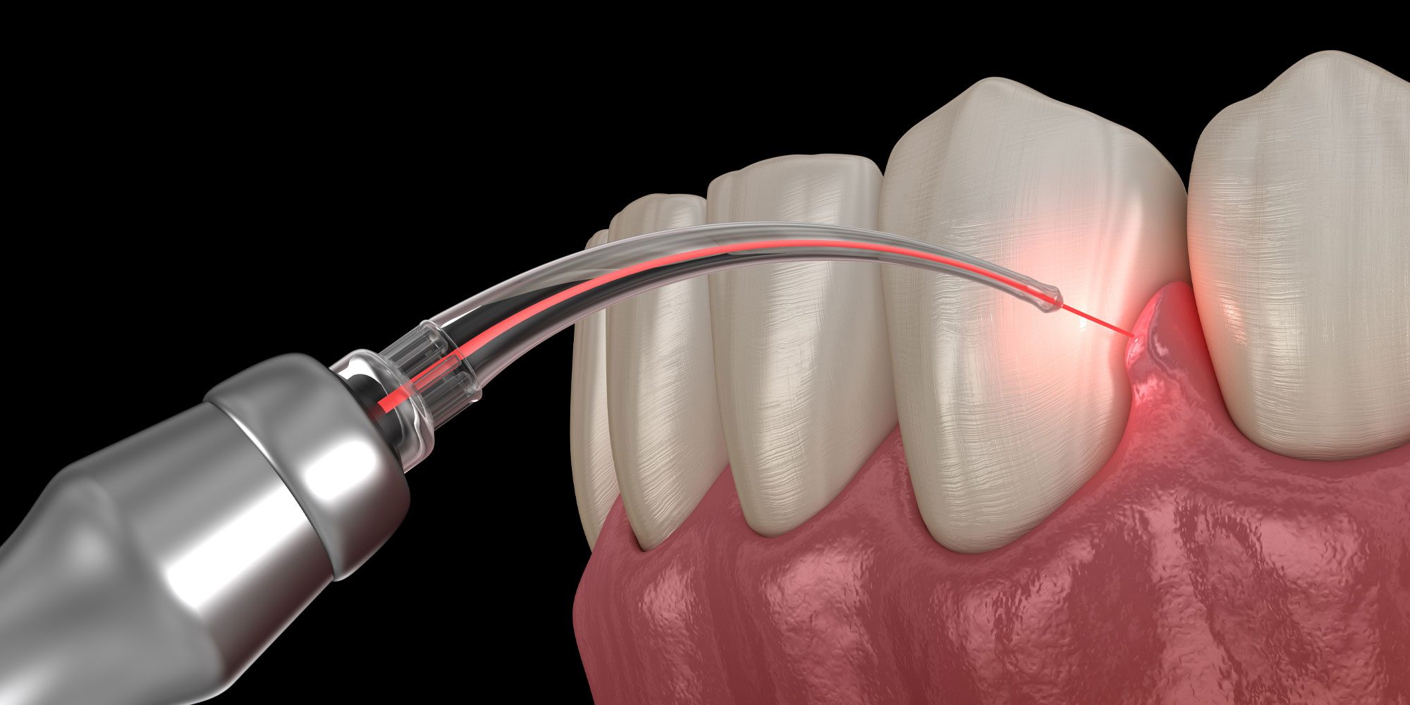 Laser Dentistry Treatment in Pimple Saudagar
