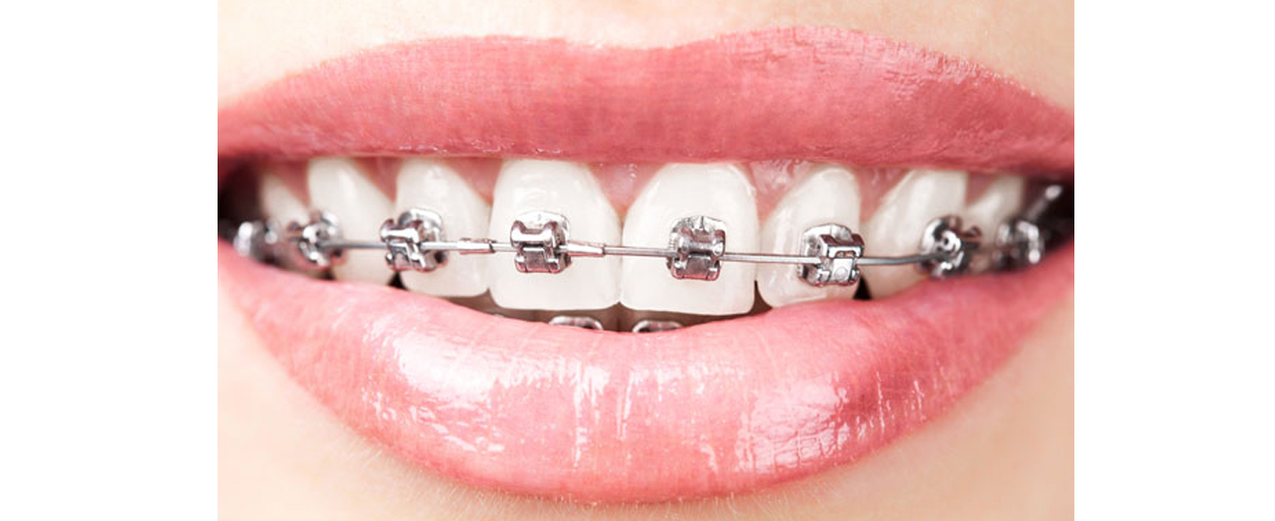 Orthodontic (Braces) in Pimple Saudagar