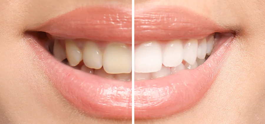 Teeth Whitening in Pimple Saudagar