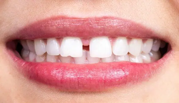 Teeth Gap Treatment in Pimple Saudagar