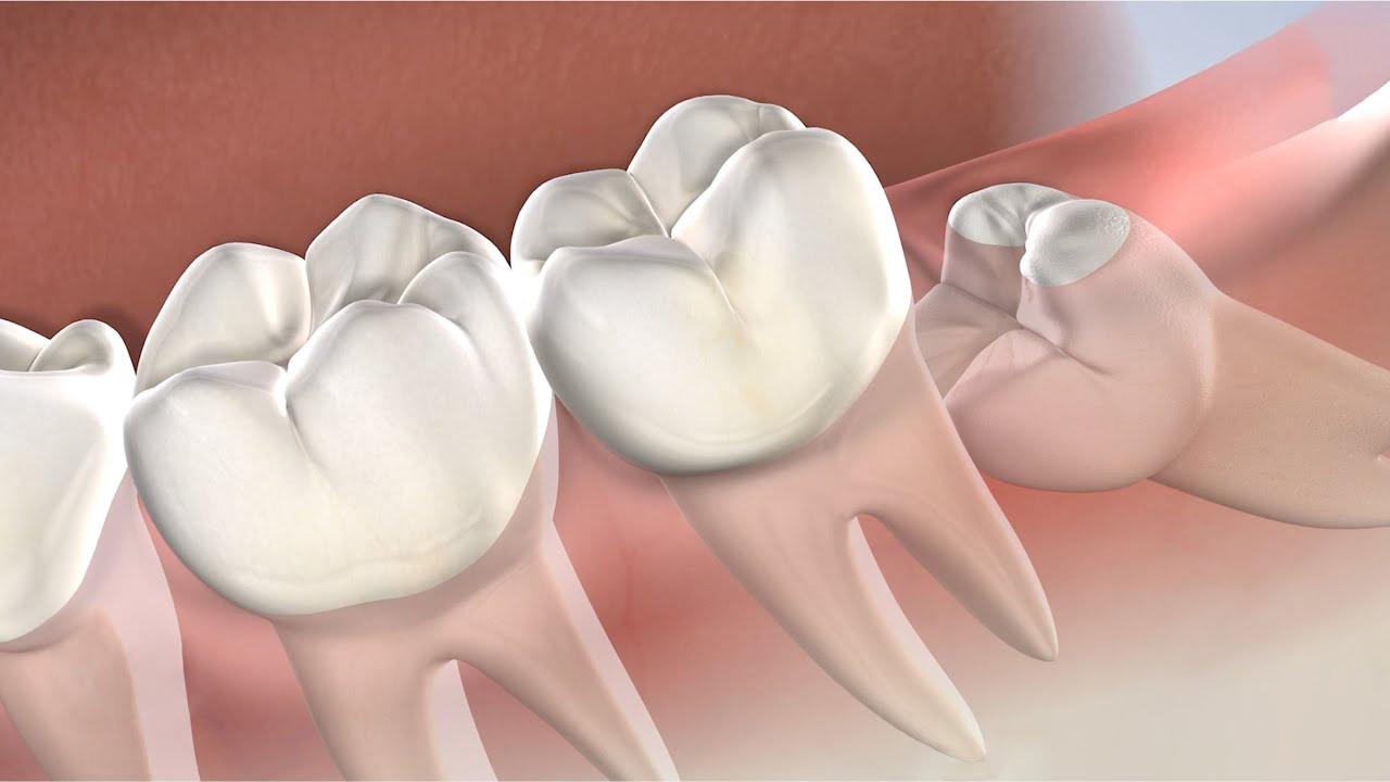 Wisdom Teeth Removal Treatment in Pimple Saudagar